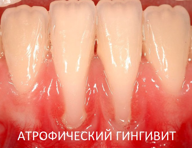 Атрофический гингивит – это прямая дорога к пародонтиту и полной потере зубов