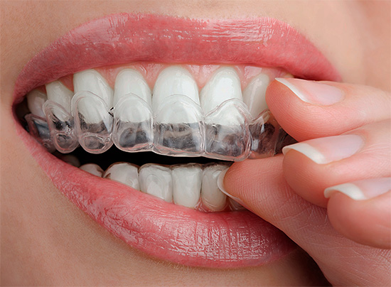 bezopasnoe-otbelivanie-zubov-19.jpg