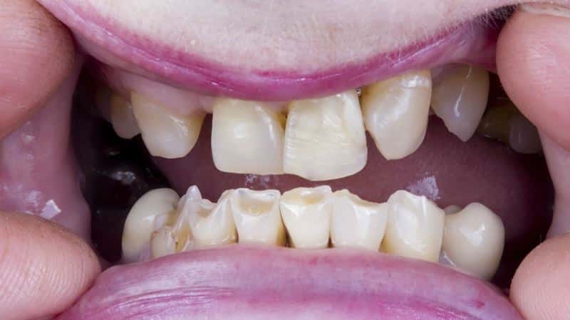Бруксизм при нарушенном прикусе особенно влияет на стачиваемость зубов