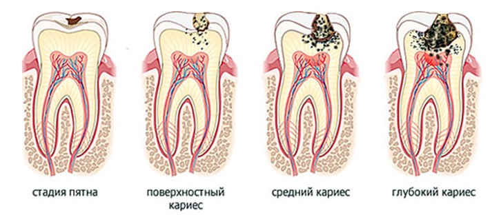 Кариес зубов - степени развития патологии