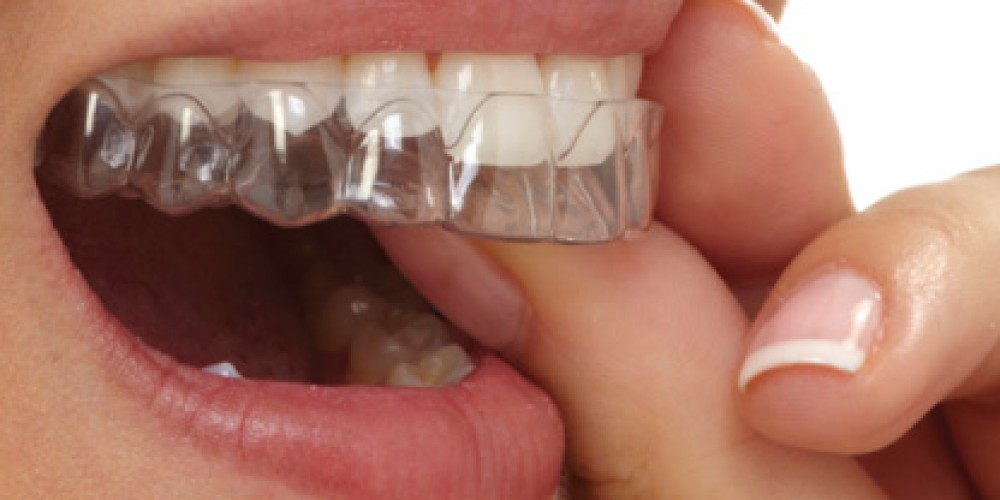 Элайнеры устанавливаются на зубы быстрее из всех систем исправления прикуса