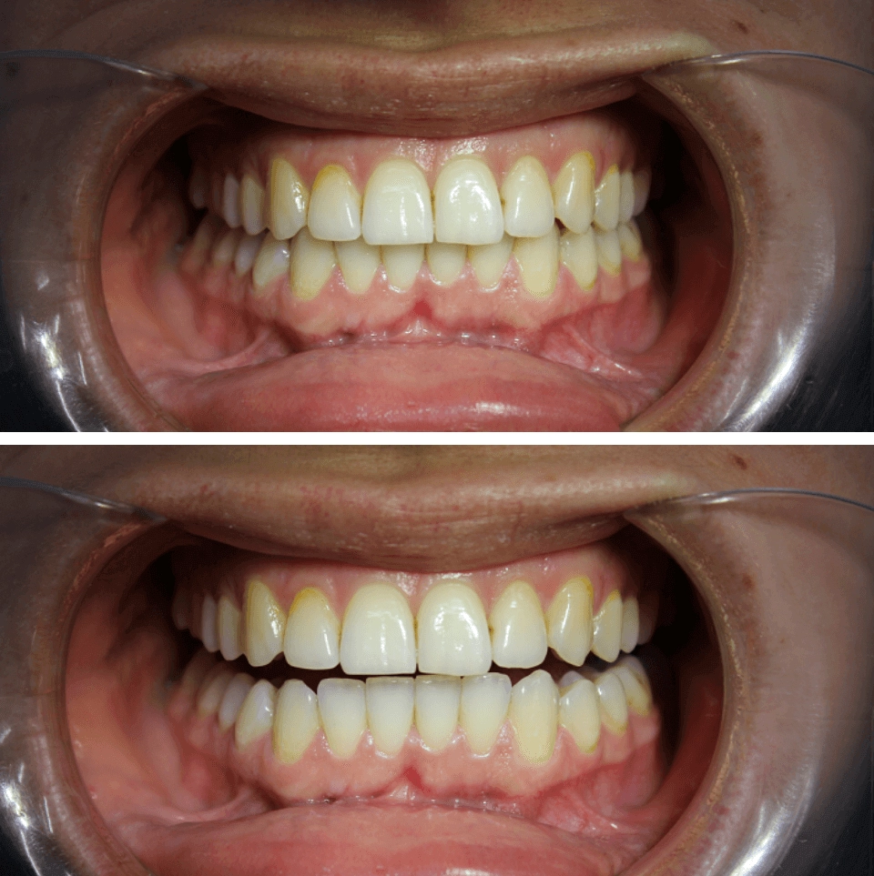 Результат лечения скученности зубов на элайнерах Star Smile