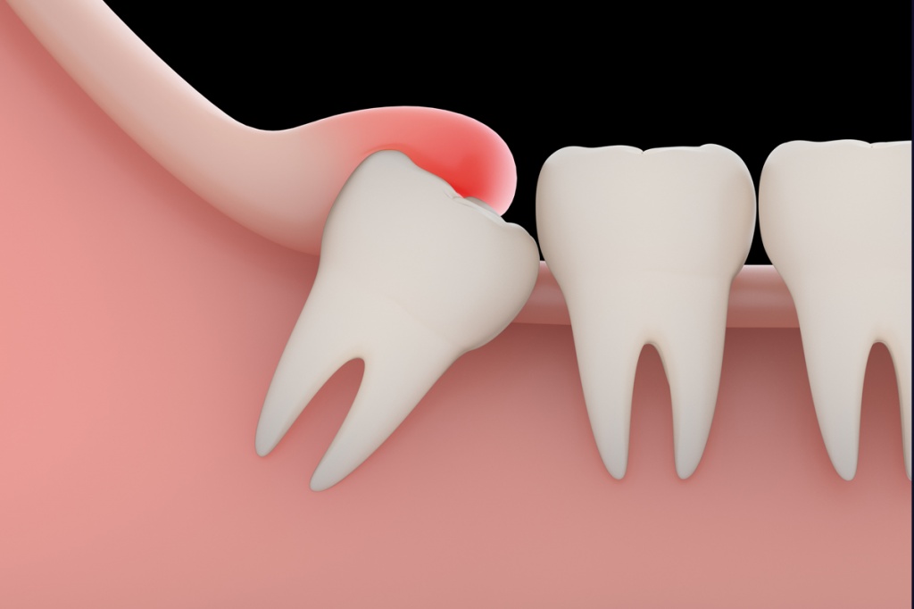 Осложнения, которые бывают при прорезывании зубов мудрости при отсутствии ретромолярного пространства