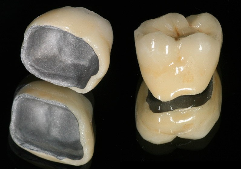 Когда зуб сильно разрушен, и керамическую коронку уже не к чему прикреплять, то используется металлокерамика или циркониевые коронки