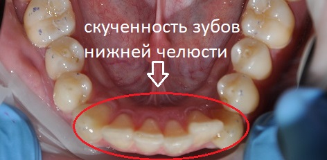 У пациента наблюдается скученное положение зубов на нижней челюсти