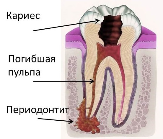 При периодонтите развивается так называемый зубной флюс – это обострение - выход гноя наружу
