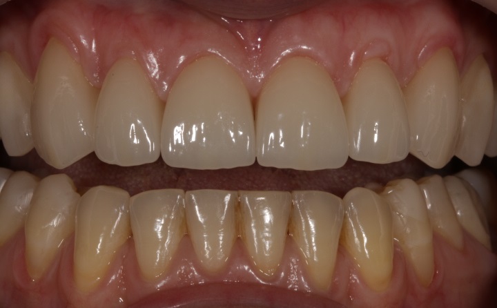 У пациентки было пожелание, чтобы зубыв результате установки виниров были максимально естественного цвета и формы