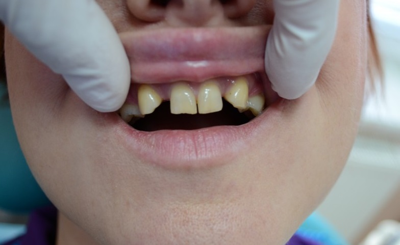 Первичная адентия, когда не образовались один или несколько зубов – встречается крайне редко