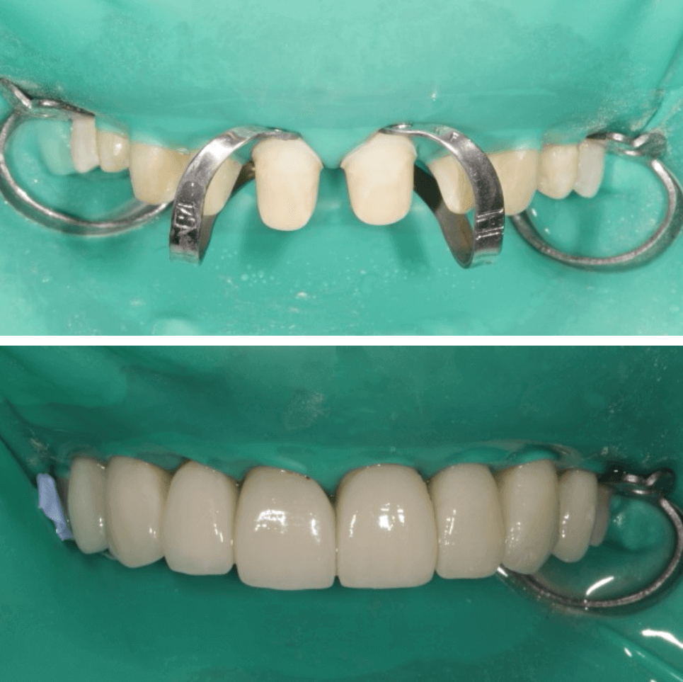 Очень важный этап фиксация конструкций на зубы - до и после