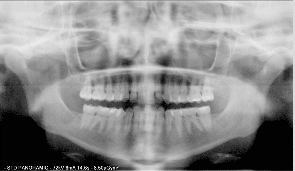Ортопантомограмма - скученность зубов на момент обращения