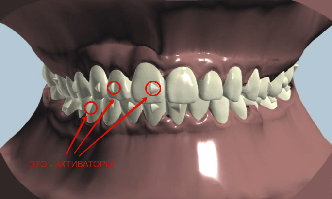  в общем и целом для этого пациента все задачи с перекрестным прикусом решены, зубы ровные, прикус правильный