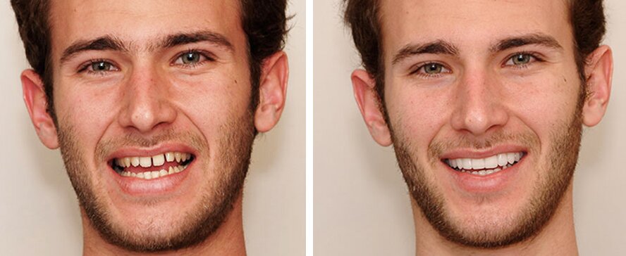 Фотографии До и После установки виниров на зубы