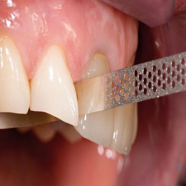 Что такое сепарация зубов и надо ли бояться этой процедуры?